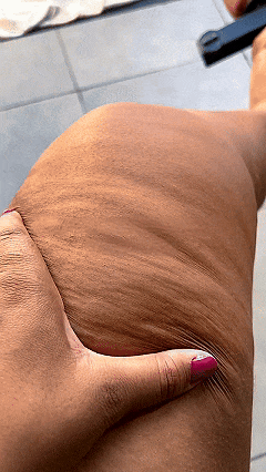 Woman with lipedema discomfort