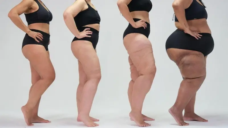 Lipedema Stages
